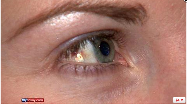 Schmuckimplantate im Auge